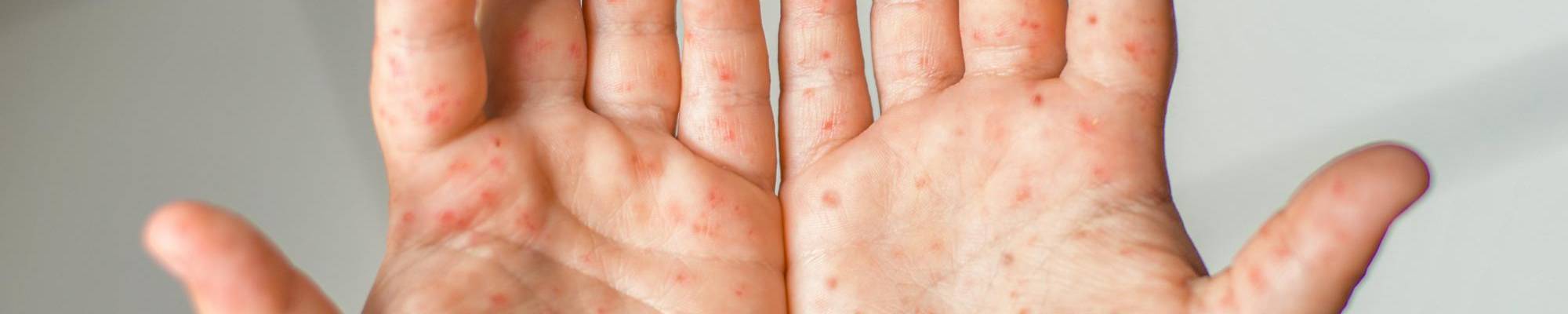 treatment for hand, foot, and mouth disease
