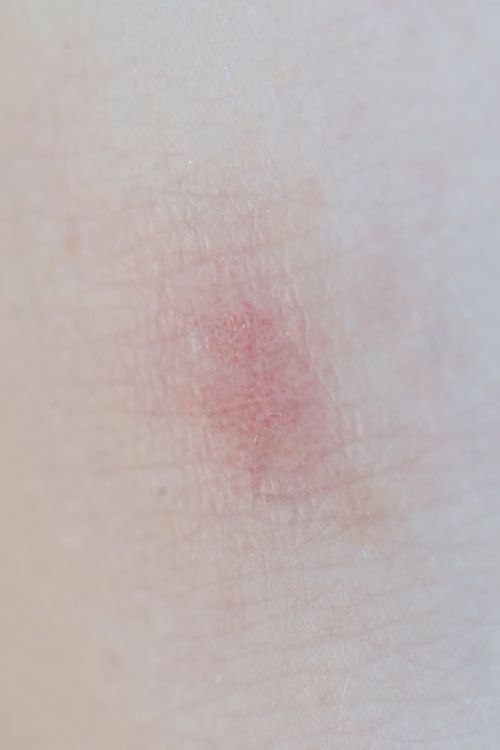 Close-up of a red skin rash on human skin